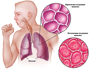 Как понять что у тебя воспаление лёгких