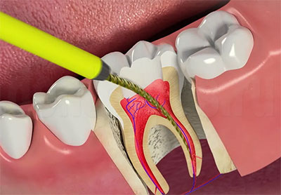 Что делать если сильно болит зуб