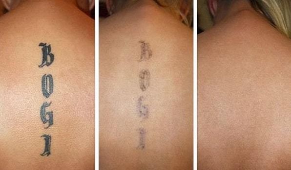 Эффективные способы ухода за кожей после процедур по удалению тату
