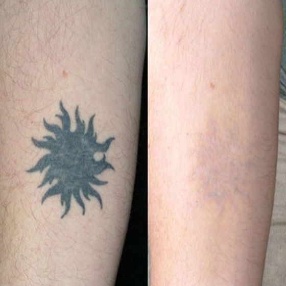 Эффективные способы ухода за кожей после процедур по удалению тату