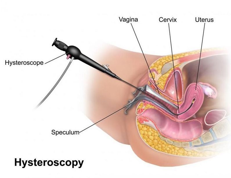 Гистероскопия и гистерорезектоскопия: Современный подход к здоровью матки